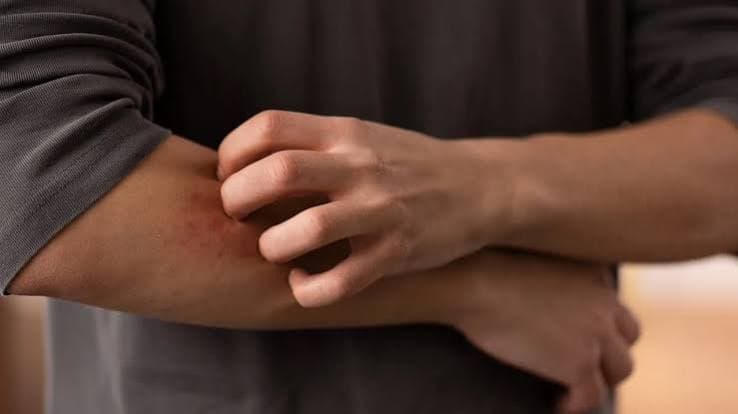 Aumento dei casi di dermatofilosi in Europa: Pregliasco rassicura sul basso rischio ma segnala cambiamenti nelle modalità di contagio